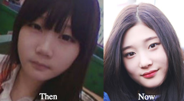 Jung Chae Yeon nose job