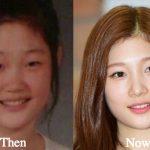 Jung Chae Yeon Plastic Surgery Before and After Photos