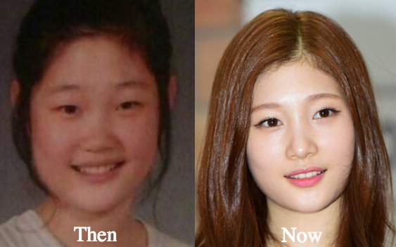 Jung Chae Yeon plastic surgery before and after photos