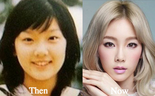 Kim Taeyeon plastic surgery before and after photos