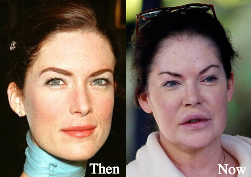 Lara Flynn Boyle plastic surgery before and after photos