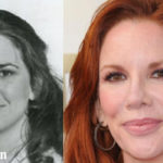 Melissa Gilbert Plastic Surgery Before and After Photos