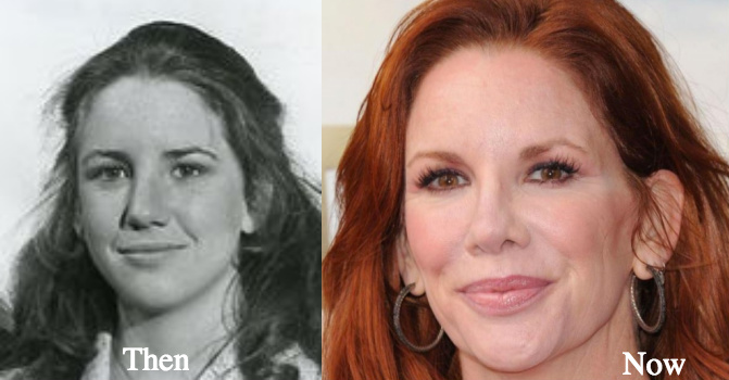 Melissa Gilbert plastic surgery before and after photos