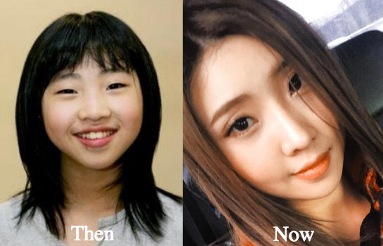 Minzy nose job before and after