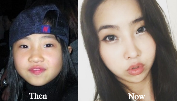 Minzy plastic surgery before and after photos