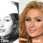 Paris Hilton Plastic Surgery Before and After Photos