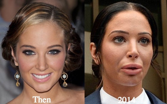 Tulisa Plastic surgery before and after photos
