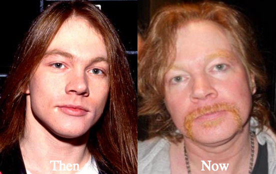 Axl Rose Botox injections