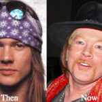 Axl Rose Plastic Surgery Before and After Photos