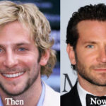 Bradley Cooper Plastic Surgery Before and After Photos