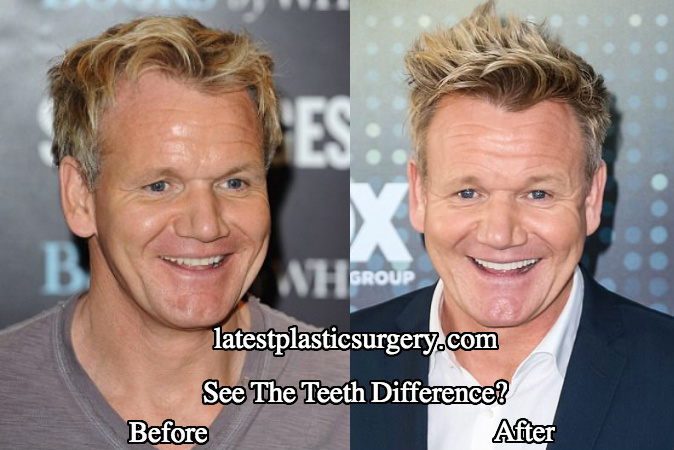 Gordon Ramsey teeth before and after photo