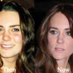 Kate Middleton Plastic Surgery Rumors – Now and Then Pictures