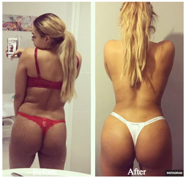 Lateysha Grace fat transfer before and after