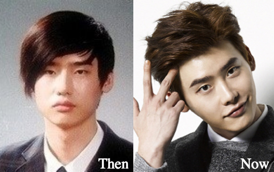 Lee jong suk plastic surgery before and after photos