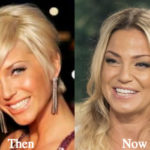Sarah Harding Plastic Surgery Before and After Photos