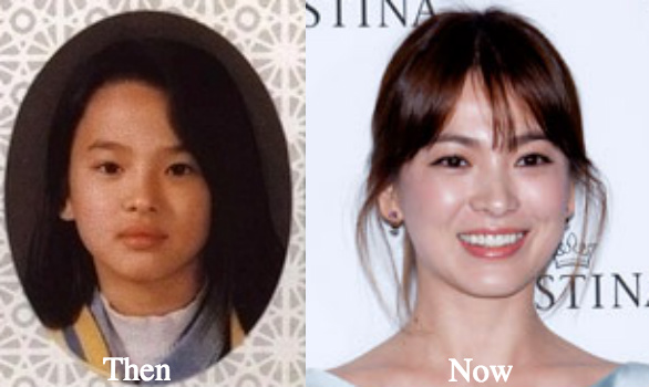 Song Hye Kyo facial fillers