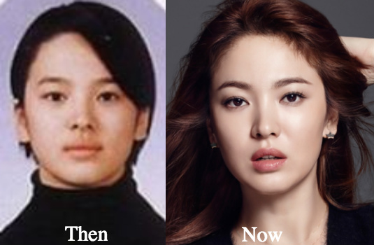 Song Hye Kyo nose job