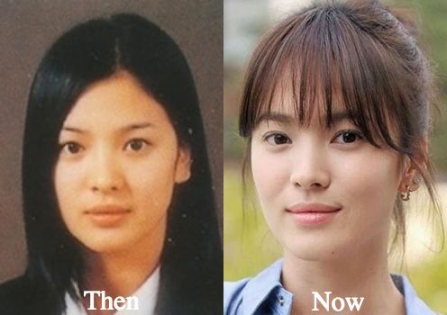 Song Hye Kyo plastic surgery before and after photos