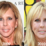 Vicki Gunvalson Plastic Surgery Before and After Photos