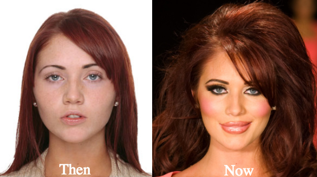 amy-childs-plastic-surgery-before-and-after-photos