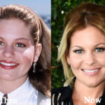Candace Cameron Plastic Surgery Before and After Photos