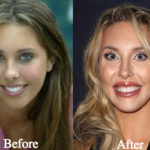 Chloe Lattanzi Plastic Surgery Before and After Photos