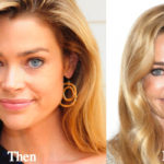 Denise Richards Plastic Surgery Before and After Photos