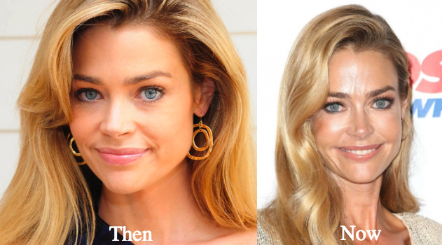 denise-richards-plastic-surgery-before-and-after-photos