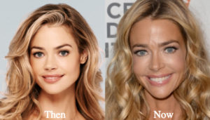 Denise Richards Plastic Surgery Before and After Photos - Latest