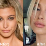 Hailey Baldwin Plastic Surgery Before and After Photos
