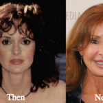 Jackie Zeman Plastic Surgery Before and After Photos