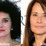 Lorraine Bracco Plastic Surgery Before and After Photos