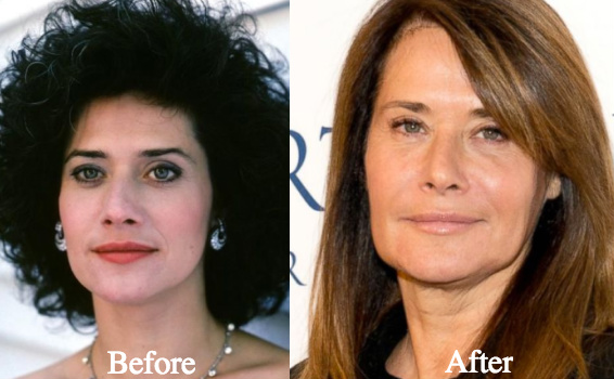 Lorraine Bracco plastic surgery before and after photos