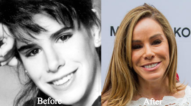 Melissa Rivers Plastic surgery before and after photos