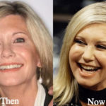 Olivia Newton-John Plastic Surgery Before and After Photos