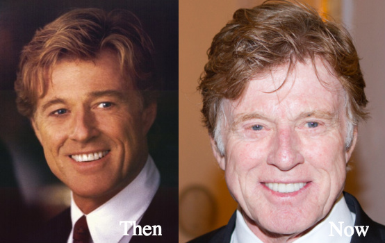 Robert Redford and facelifts