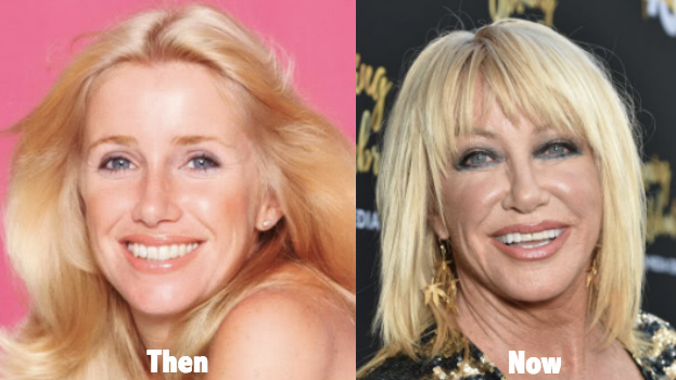 suzanne-somers-plastic-surgery-before-and-after-photos