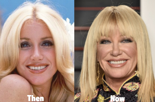 suzanne-somers-botox-lip-fillers