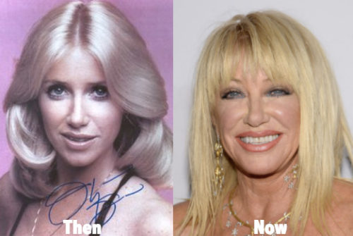Suzanne Somers Plastic Surgery Before And After Photos Latest Plastic Surgery Gossip And News