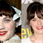 Zooey Deschanel Plastic Surgery Before and After Photos