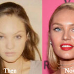 Candice Swanepoel Plastic Surgery Before and After Photos