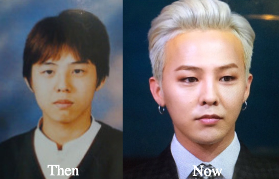 dragon-g-plastic-surgery-before-and-after-photos