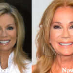 Kathie Lee Gifford Plastic Surgery Before and After Photos
