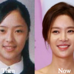 Hwang Jung Eum Plastic Surgery Before and After Photos
