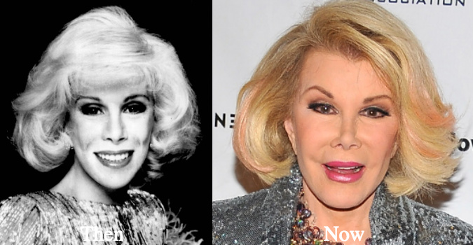 joan-rivers-age-and-nose-job