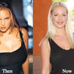 Katherine Heigl Plastic Surgery Before and After Photos
