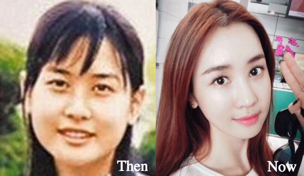 lee-da-hae-before-and-after
