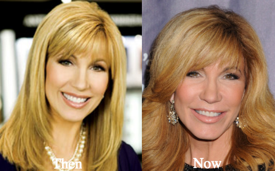 leeza-gibbons-plastic-surgery-rumors-before-and-after-photos