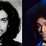 Prince Plastic Surgery Before and After Photos