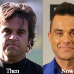 Robbie Williams Plastic Surgery Before and After Photos